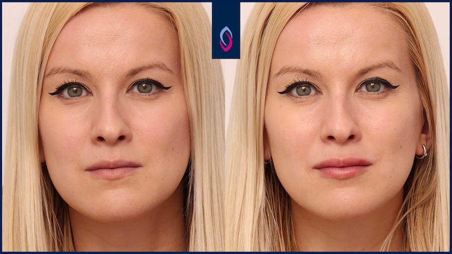lippen-aufspritzen-vorher-nachher-blond